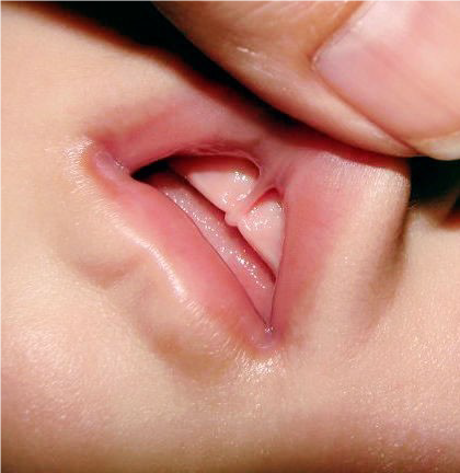 Child Lip Frenum