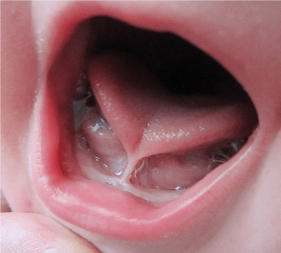 Child Tongue Frenum